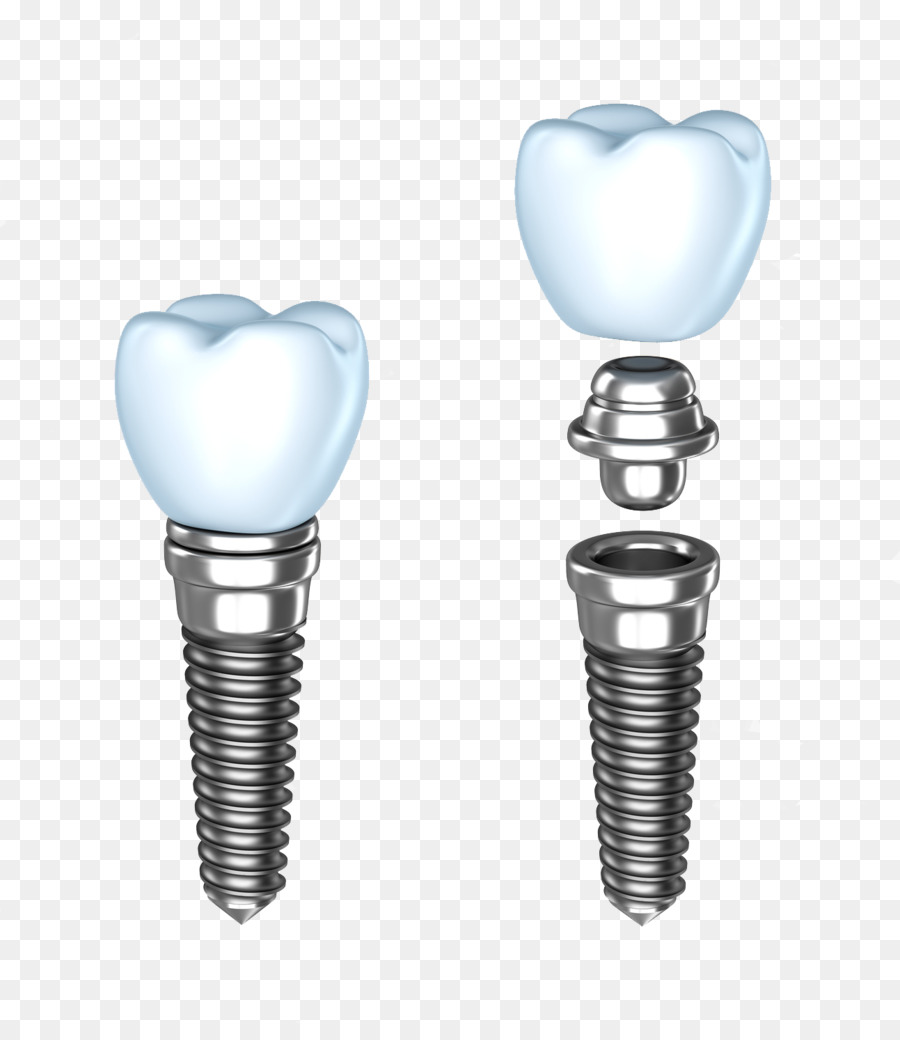 IMplantologia dentale